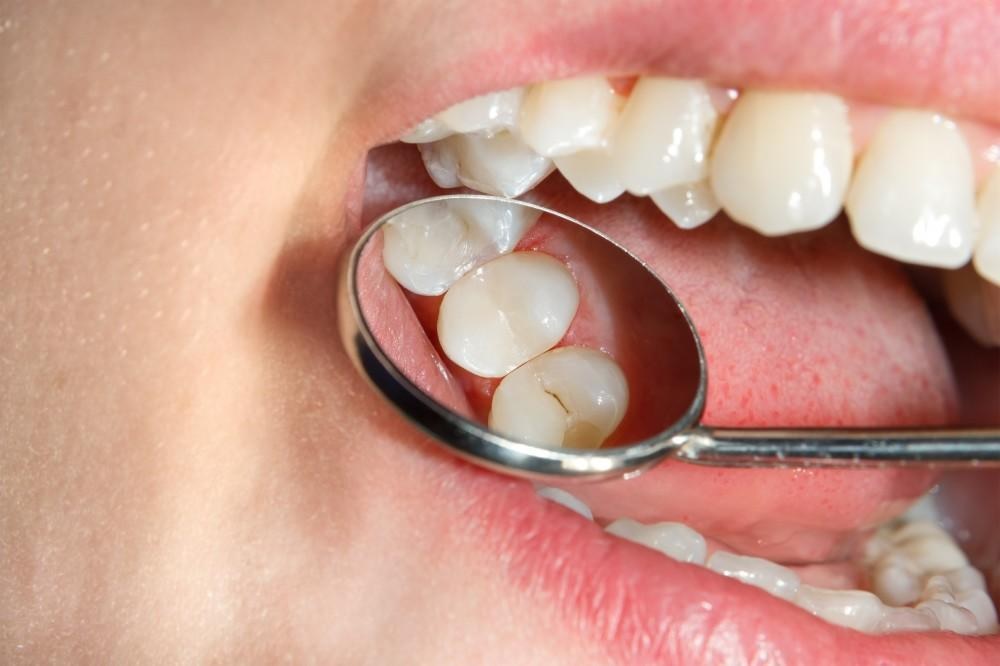 The Benefits of Adult Dental Sealants