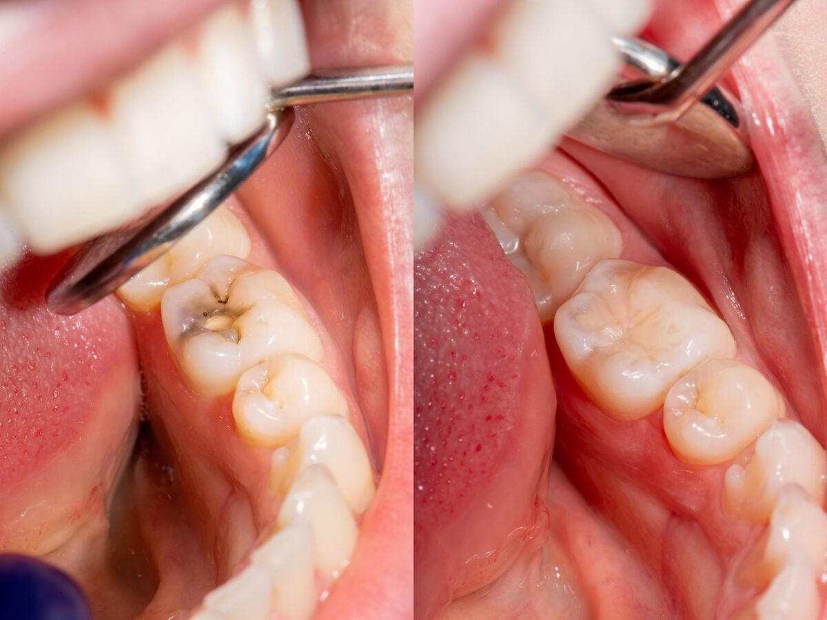 everything you need to know about composite fillings